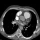 CTEPH, chronic thromboembolic disease, pulmonary hypertension, mosaic perfusion: CT - Computed tomography